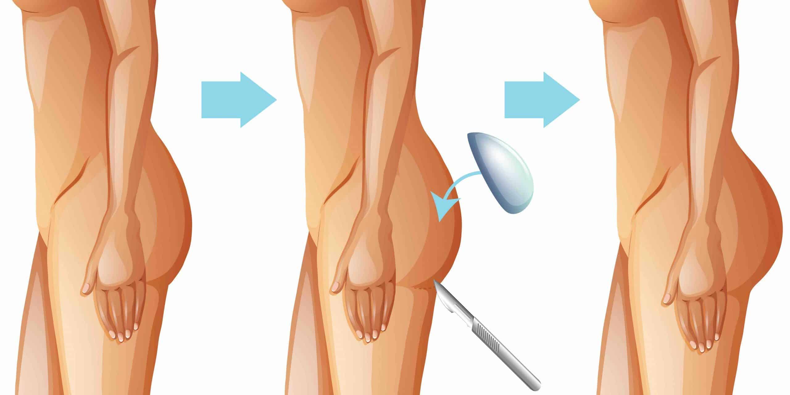 Gluteoplastia: Aumento de Glúteos com Prótese ou Gordura Enxertada?