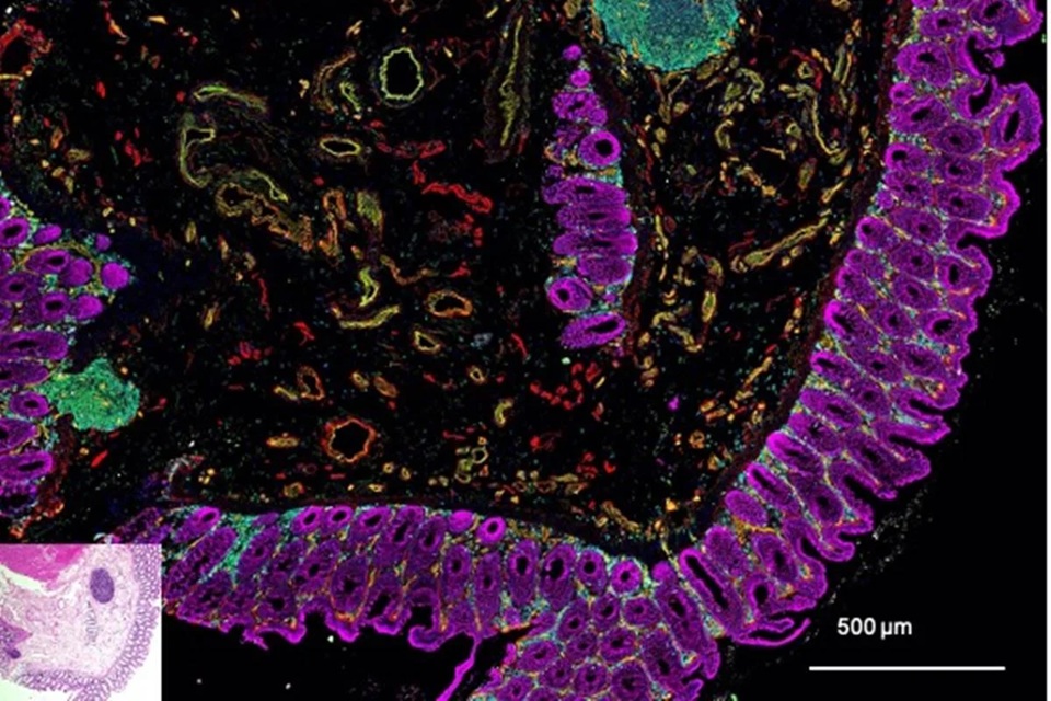 Nova pesquisa revela conexão entre toxina bacteriana e câncer no intestino grosso; saiba mais